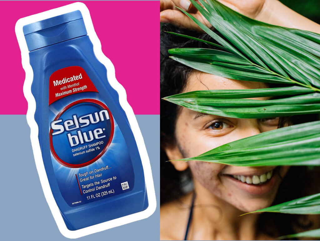 selsun blue for acne