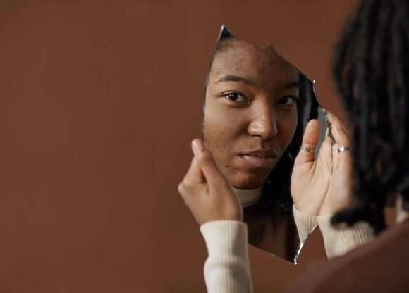 Hormonal Acne Vs Fungal Acne -Woman with hormonal acne on the face_looking in mirror