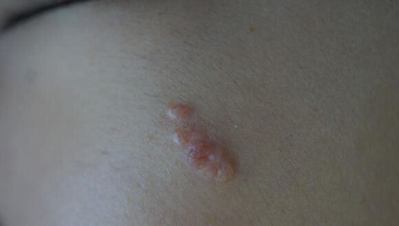 A close-up of a sebaceous gland hyperplasia bump on the skin