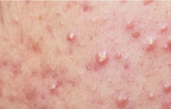 An image showing the close-up view of a skin lesion with enlarged sebaceous glands, which is a characteristic feature of sebaceous hyperplasia