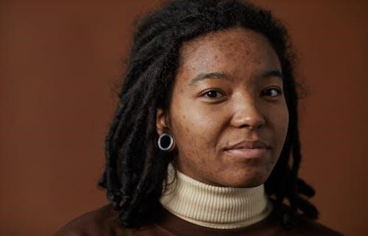Young woman, with hyperpigmentation (dark spots) from acne and fungal acne