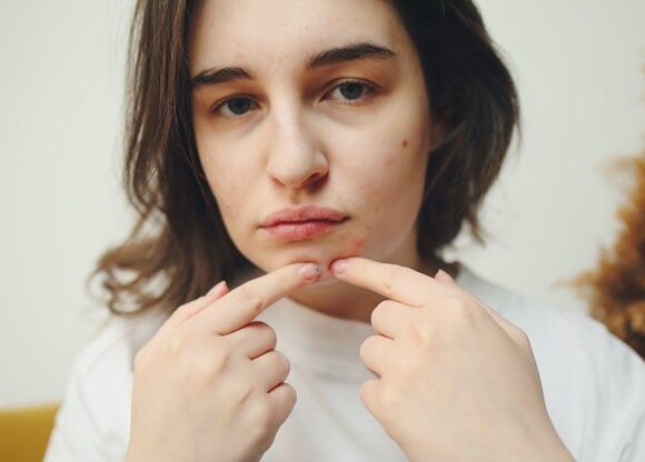 Woman with hormonal acne and bacterial acne on her chin