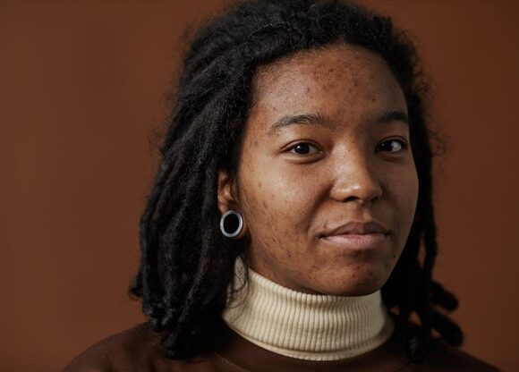 Young African American Woman, with both hormonal and bacterial acne on her face