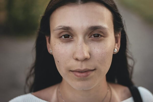 Female Face Free from Fungal Acne Natural Treatments