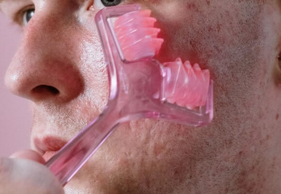 Is Benzoyl Peroxide Good for Fungal Acne - Young man with derma roller device on face treating acne