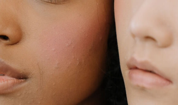 Bacterial Acne - Header woman of color with fungal acne