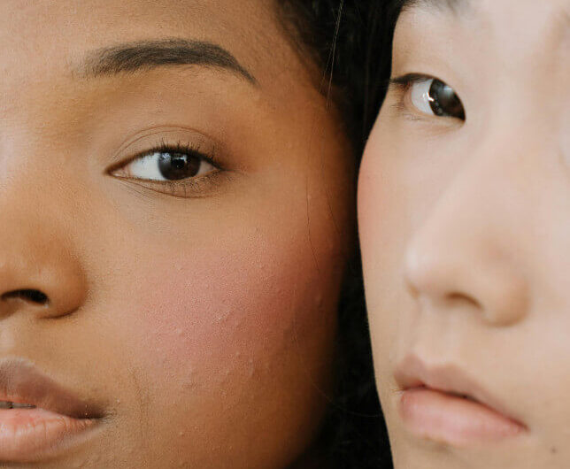 Fungal Acne Black Skin Guide Symptoms & Solutions