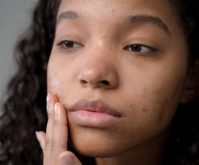 Understanding Fungal Acne on Black Skin