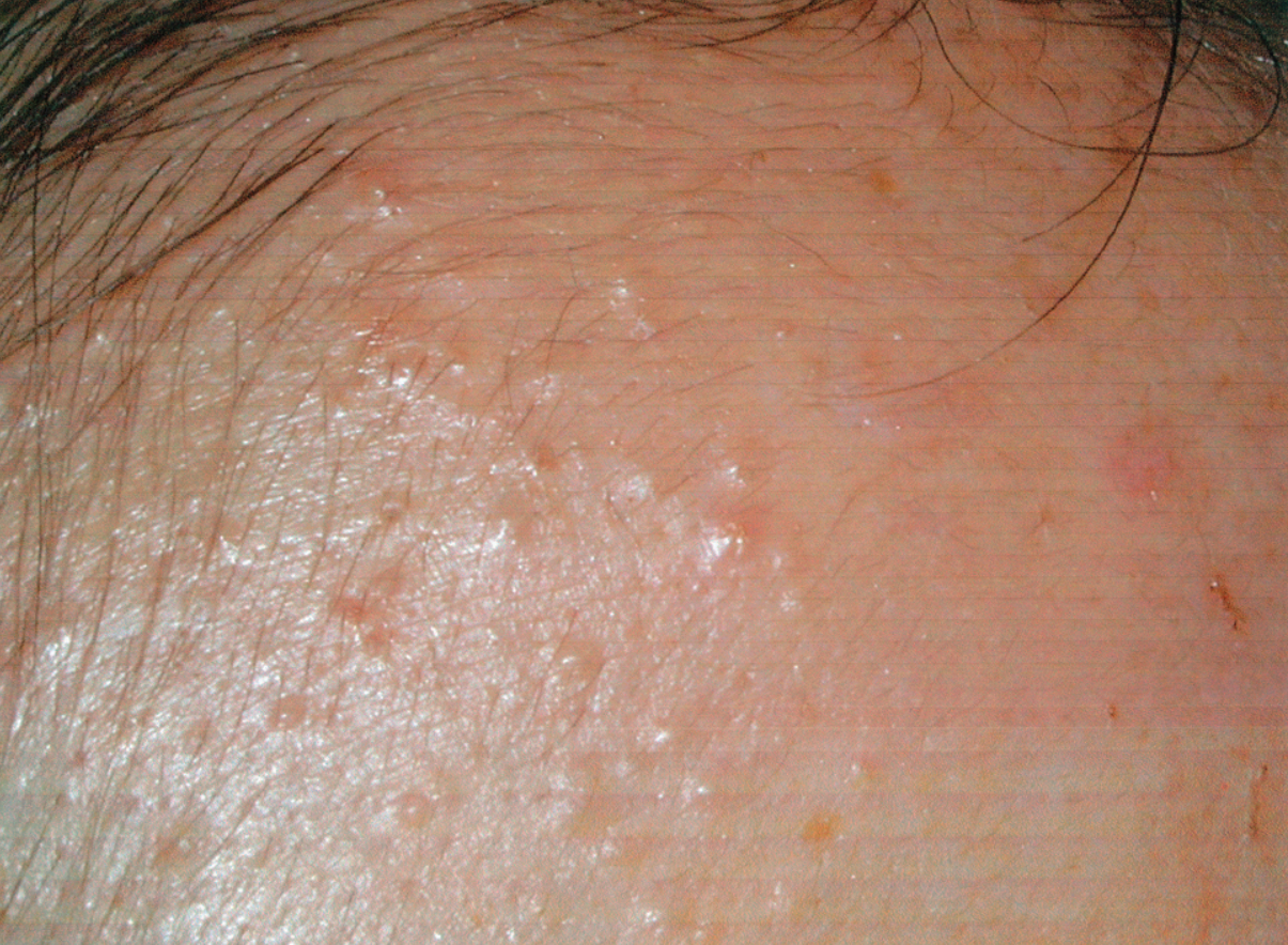 A Close Up Of What Fungal Acne Looks Like On The Forehead