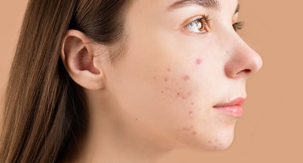 female small inflammatory acne