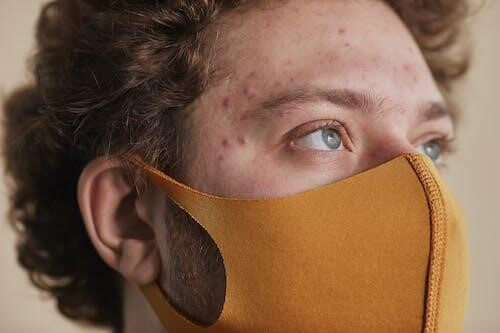 Young man wearing mask, with forhead fungal acne and bacterial acne (acne vulgris)