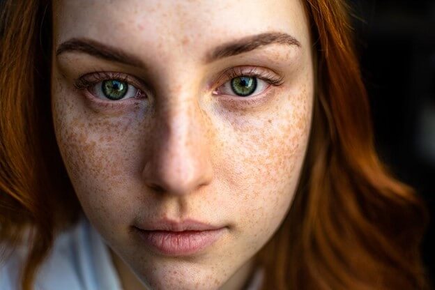 How To Treat Fungal Acne On Face Naturally