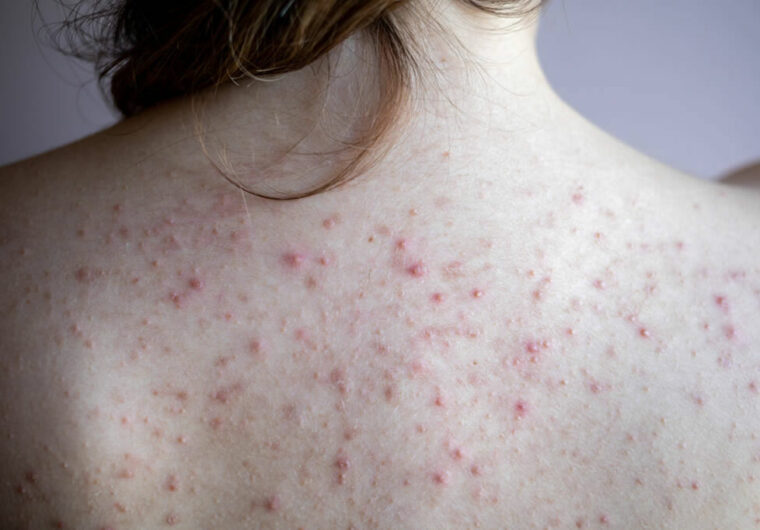 Combat Fungal Acne on Back Must-Have Products for Clear, Health