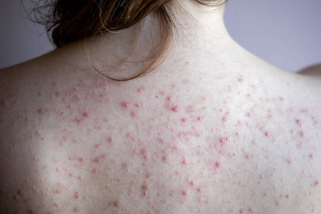 Combat Fungal Acne on Your Back: Must-Have Products for Clear, Healthy ...