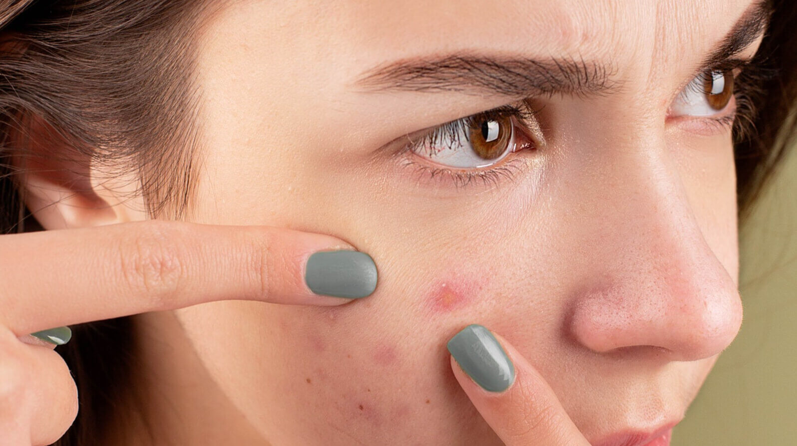 Azelaic Acid For Acne - Young Female, With Acne Scars (Hyperpigmentation, Popping A Pimple