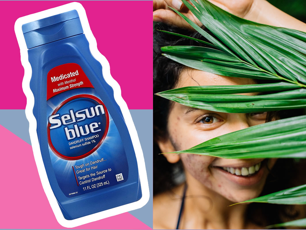 Selsun Blue For Acne - Maximum Strength Medicated Dandruff Shampoo Effective Treatment For Yeast Pimples (Fungal Acne)