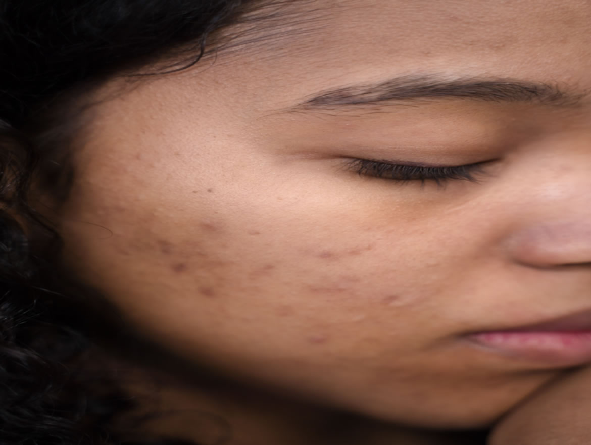 Female With Adult Acne