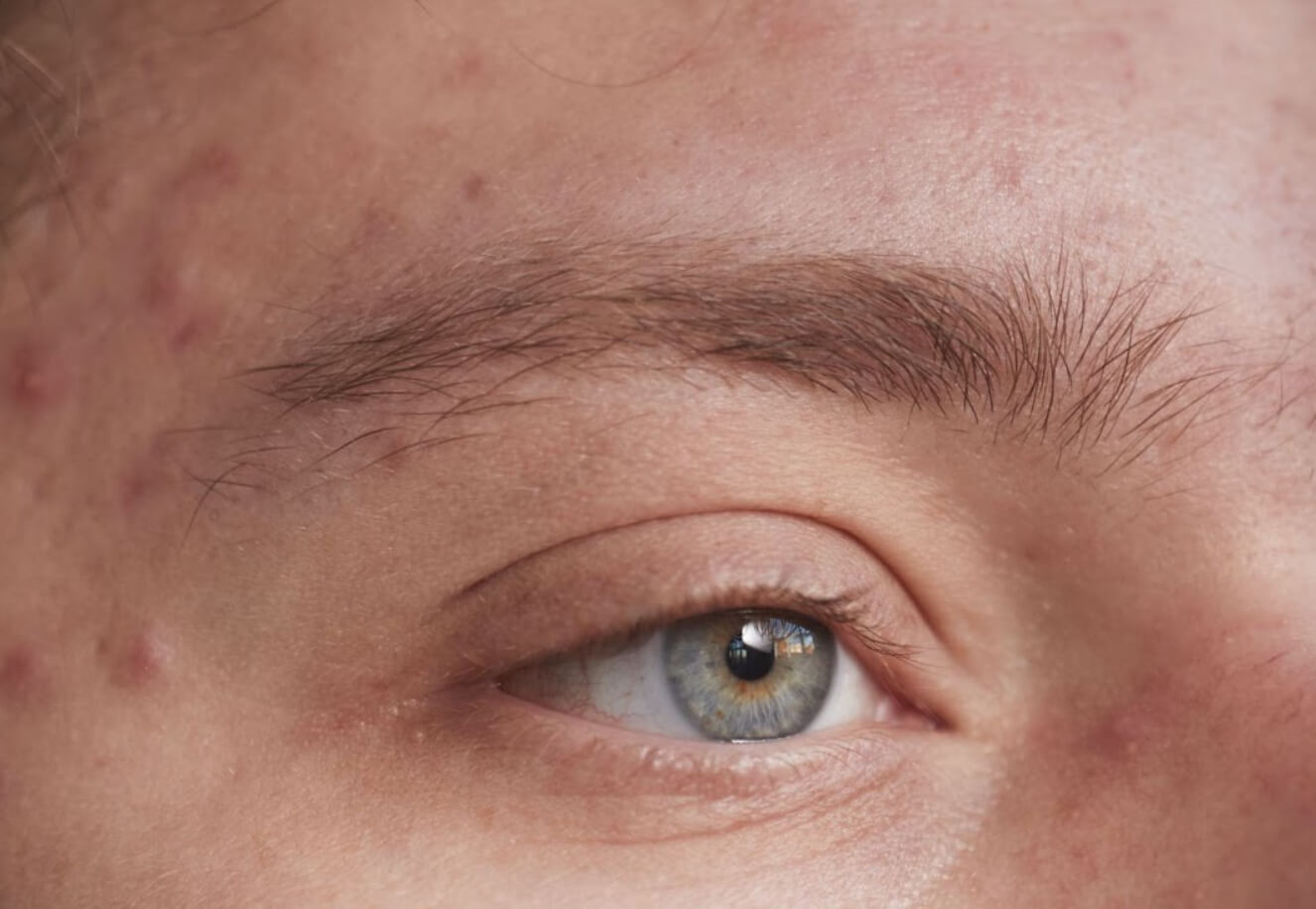 Male With Adult Acne On Face