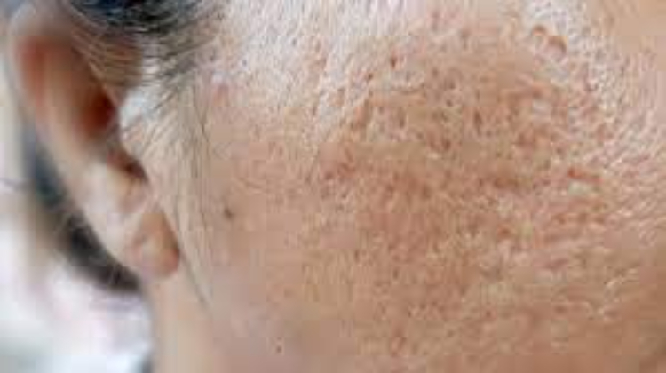 Adult-Face_Pitted_Acne_Large-Pore- Azelaic Acid For Ance