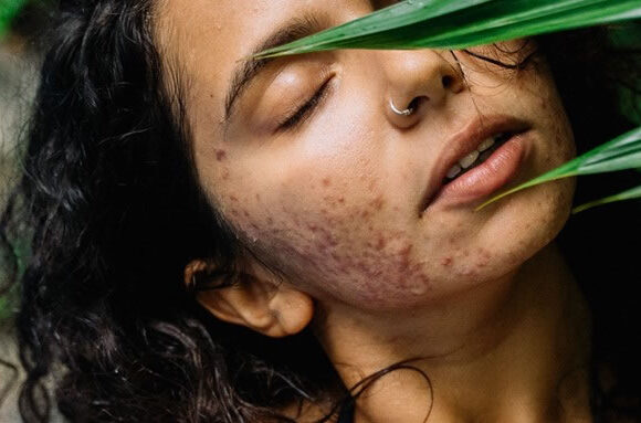 Hormonal Acne Vs Fungal Acne - What's The Difference