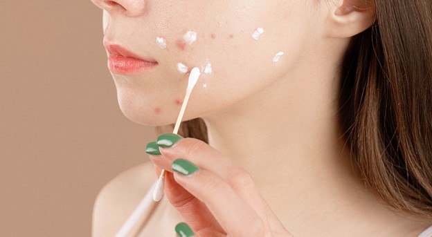 Young Lady spot treating fungal acne with sulfur mask