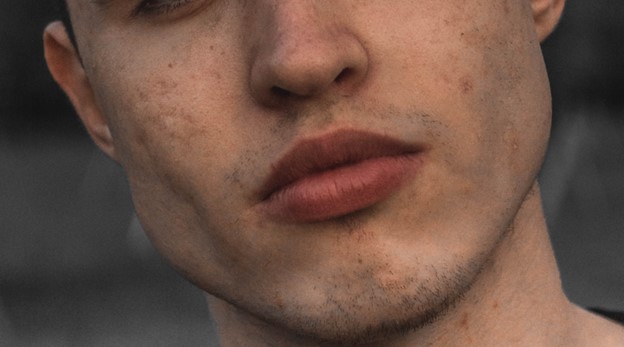 Young Man with pitted acne_ treated with Sulfur