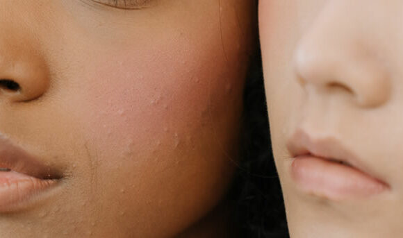 Bacterial Acne - Header woman of color with fungal acne