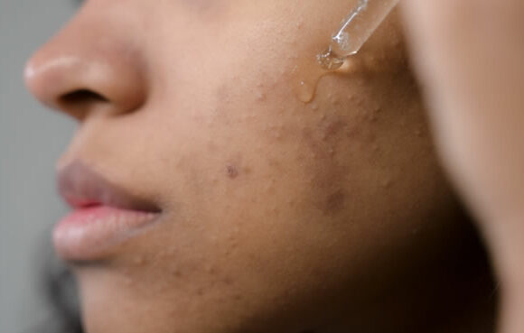 Fungal Acne Vs Bacterial Acne - woman of color treating bacterial acne with Mandelic Acid Serum