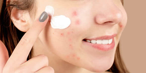 Fungal Acne Vs Bacterial Acne - woman treating bacterial acne with benzoyl peroxide