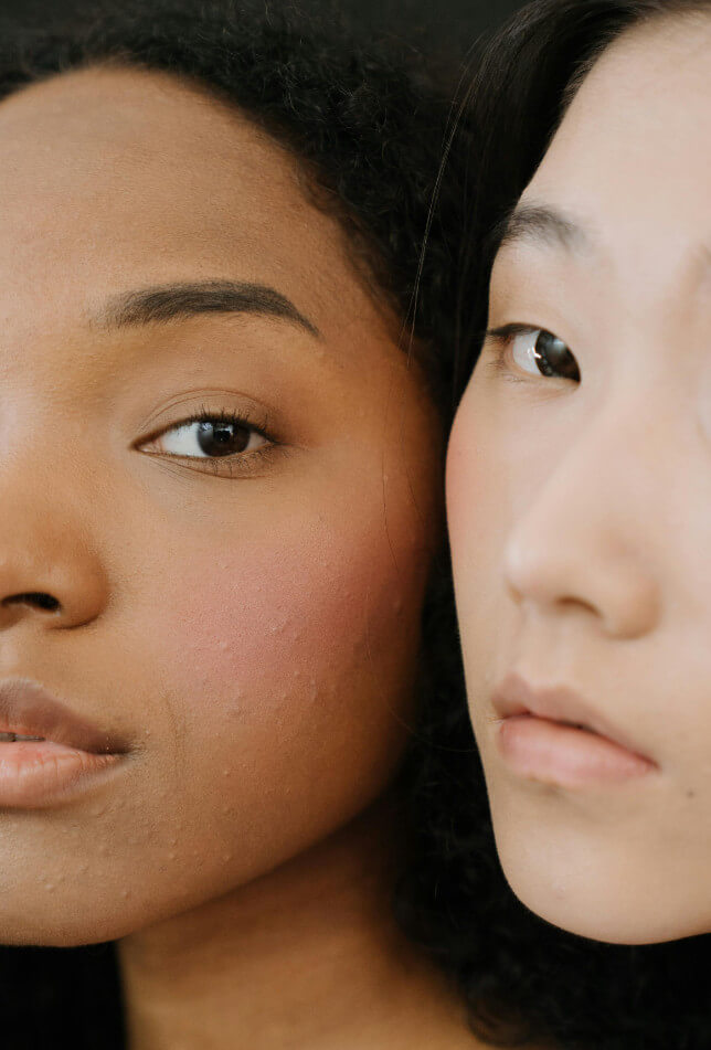 Fungal Acne Black Skin Guide Symptoms & Solutions