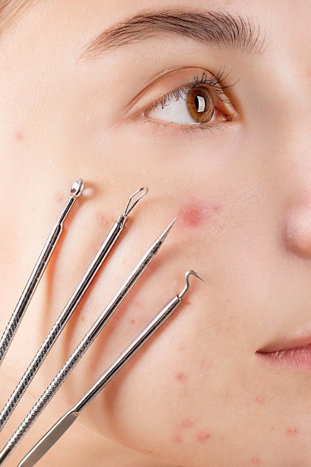Fungal vs Bacterial Acne Spot the Difference and Treat It Fungal vs Bacterial Acne Spot the Difference and Treat It